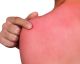Sunburn? This Will Give You Immediate Relief