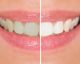 5 Tips to Avoid Staining Your Teeth from Coffee and Red Wine