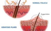 What Are Those Red Spots On Your Arms And Legs?
