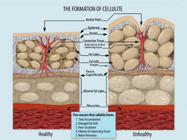 What Causes Cellulite?