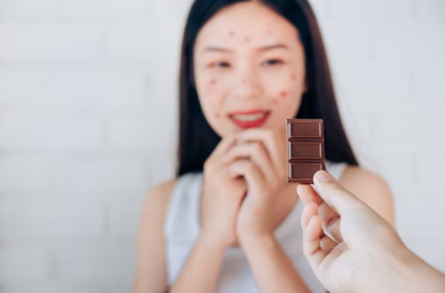 19) Chocolate Causes Acne