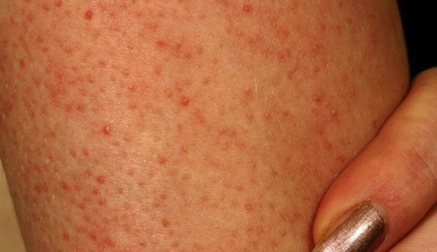 What Are Those Red Spots On Your Arms Legs?